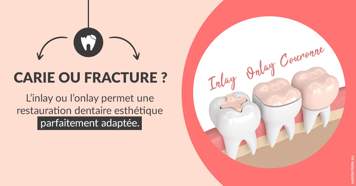 https://dr-benichou-laurence.chirurgiens-dentistes.fr/T2 2023 - Carie ou fracture 2