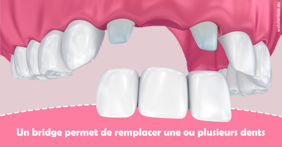https://dr-benichou-laurence.chirurgiens-dentistes.fr/Bridge remplacer dents 2
