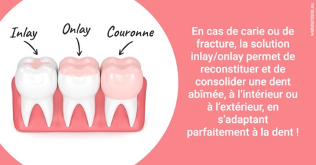 https://dr-benichou-laurence.chirurgiens-dentistes.fr/L'INLAY ou l'ONLAY 2