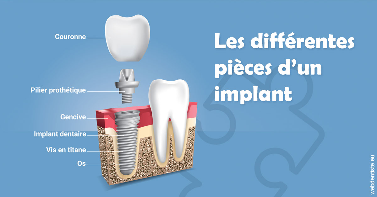 https://dr-benichou-laurence.chirurgiens-dentistes.fr/Les différentes pièces d’un implant 1
